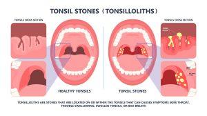tonsil,stones,crypts,viral,virus,gland,strep,throat,sore,enlarged