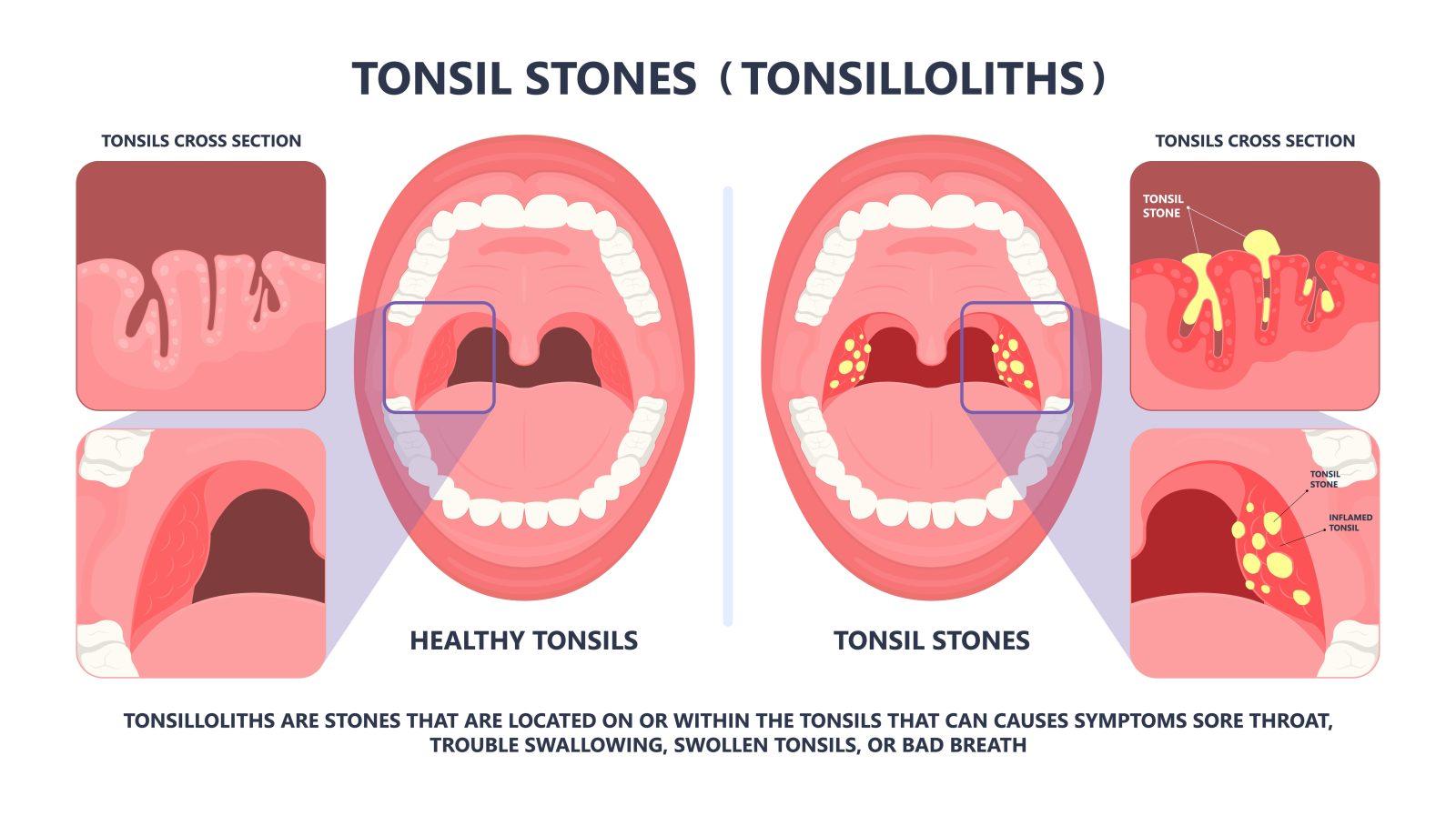Tonsil Stones All You Need To Know London ENT Tonsil Stones All You Need To Know London ENT